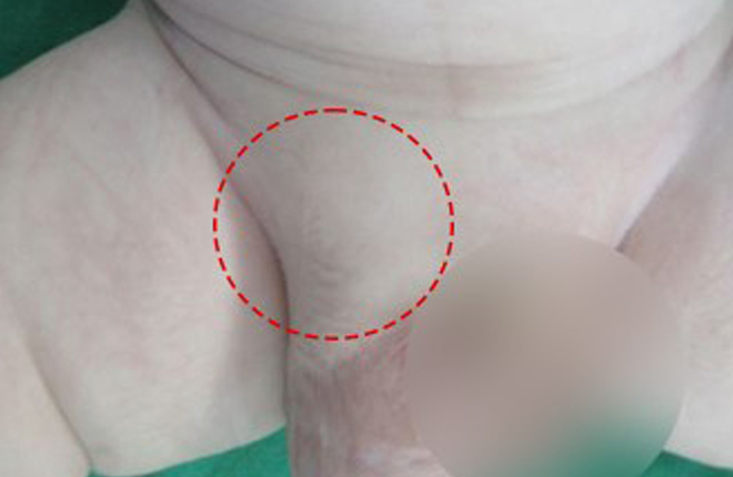 남아탈장